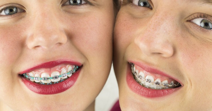 crooked teeth treatment बच्चों के टेढ़े-मेढ़े दांत